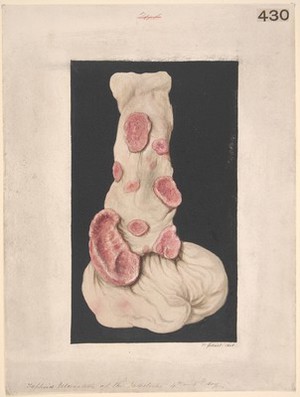 view Condition of the intestine in enteric fever at the fourth or fifth day