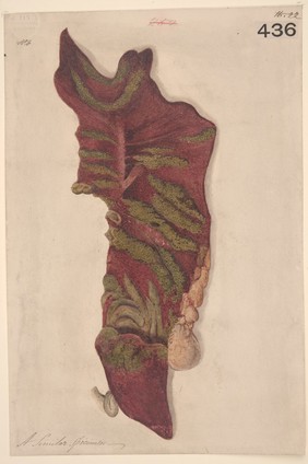 Sloughing of the mucous membrane in the colon in enteric fever