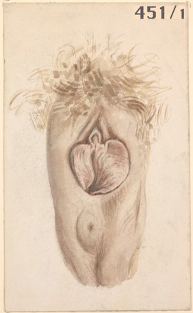 Recto-vaginal fistula