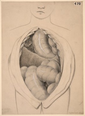 Diaphragmatic hernia