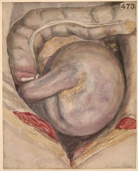 Volvulus of the ascending colon