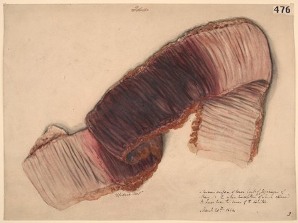 Intussusception of the jejunum