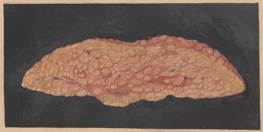 Cirrhosis, with fatty degeneration of the liver