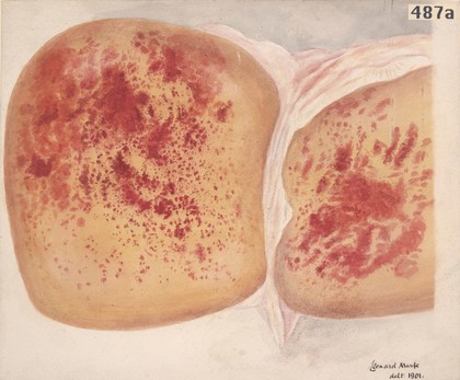 Liver from a woman who died of puerpal eclampsia