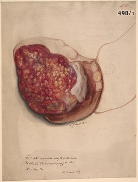 Liver with suppuration extending along the portal canals
