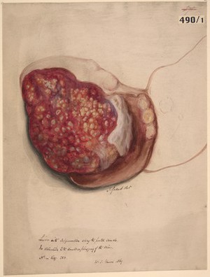 view Liver with suppuration extending along the portal canals