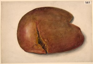 view Extensive rupture of the liver