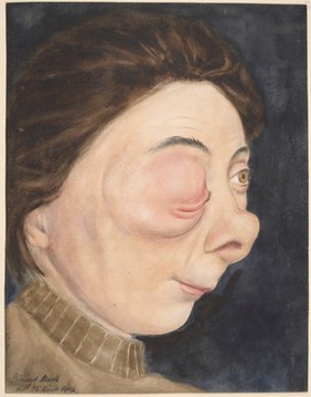 Face of a woman affected with lymphangiectasis