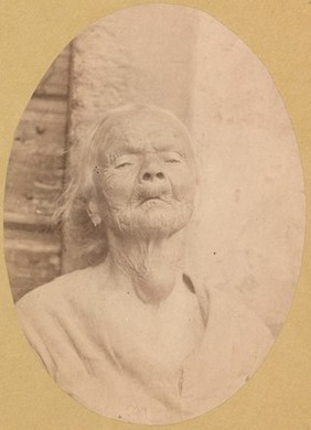 Old woman with prominent cystic goitre