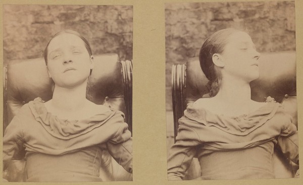 Girl exhibiting an early stage of parenchymatous goitre