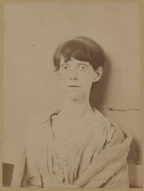 Woman with exophthalmic goitre