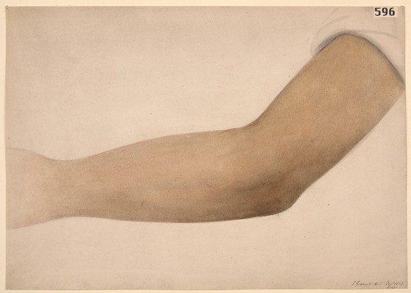 Arm with deep bronzing of the skin associated with Addision's disease