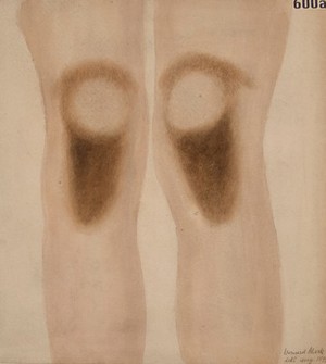 view Knees of a woman with Addison's disease