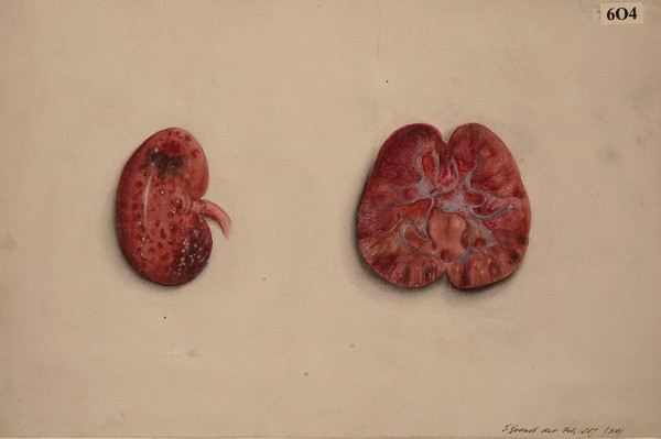 Kidney in a condition of acute interstitial nephritis