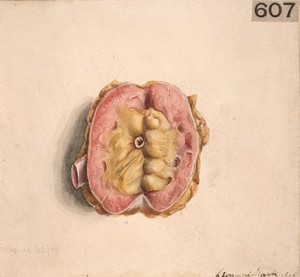 view Diseased kidney