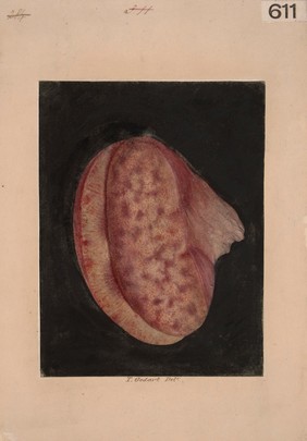 Mottled kidney at an early stage of degeneration