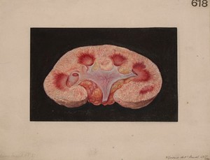 view Kidney from a case of chronic parenchymatous nephritis