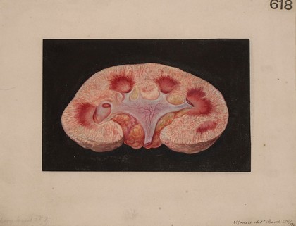 Kidney from a case of chronic parenchymatous nephritis