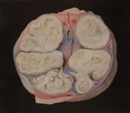 Tubercular kidney