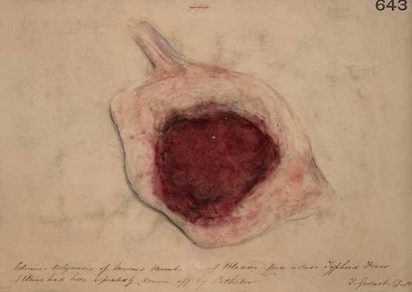 Extreme ecchymosis of the mucous membrane of the bladder from a case of enteric fever