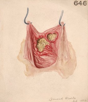 Interior of a bladder with two tubercular ulcers