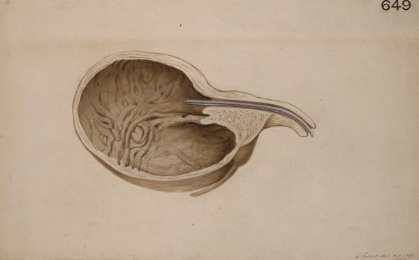 Hypertrophy of the inter-uretal fold of a bladder