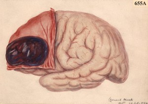 view Subcranial haemorrhage over the anterior part of the left cerebral hemisphere