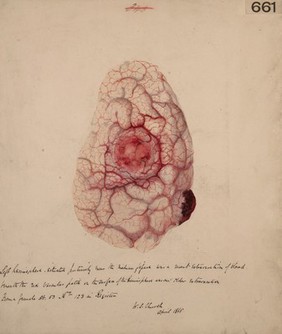 Left hemisphere of the brain showing a recent and older extravasation of blood