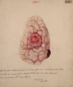 view Left hemisphere of the brain showing a recent and older extravasation of blood