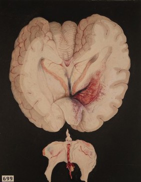 Unusual form of cerebral haemorrhage