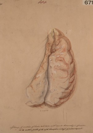 view Softening of portions of brain substance with small haemorrhagic effusions