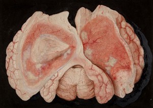 view Acute inflammation of the brain substance