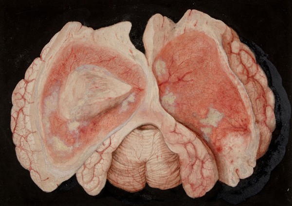 Acute inflammation of the brain substance