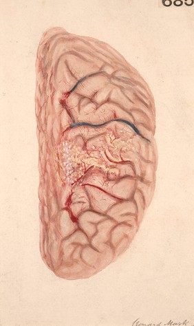 Left hemisphere of the brain, showing an area of diffuse suppurative meningitis