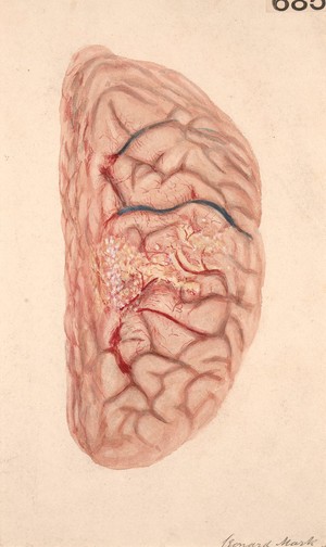 view Left hemisphere of the brain, showing an area of diffuse suppurative meningitis