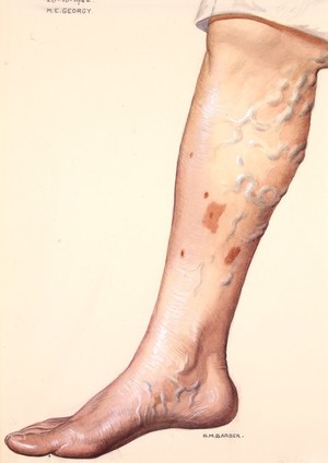 view Varicose veins affecting the lower leg
