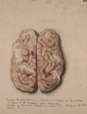 view Surface of the cerebral hemispheres, from a case of tubercular meningitis