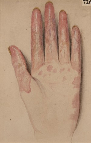 view Left hand of a woman with general neuritis