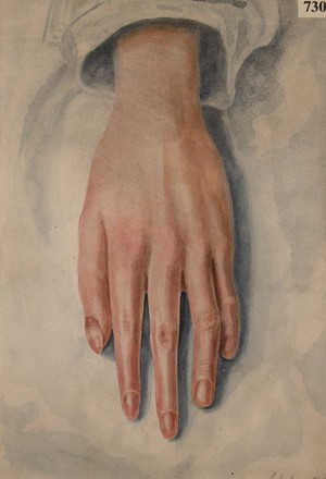 view Left hand of a patient whose median nerve was divided three years previously