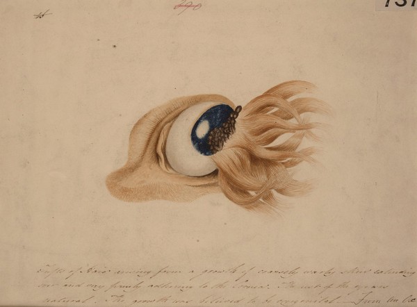 Ox eye with a growth of warty skin bearing tufts of hair, extending over the cornea