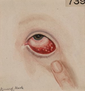 view Eye with mass of granulations occupying the palpebral conjunctiva