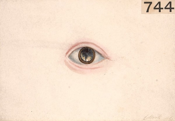 Eye of a child with intra-ocular tumour