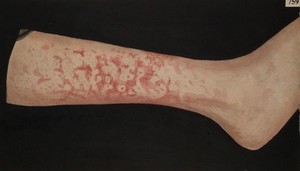 view Leg with erythema marginatum