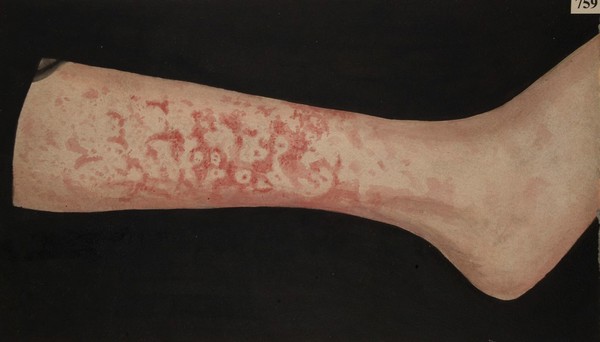 Leg with erythema marginatum