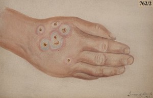 view Skin eruption on the hand