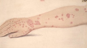 view Erythema circinatum of an arm