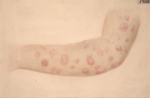 view Erythema multiforme on the arm of a child