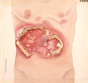 view Abdomen from a case of epidermolysis bullosa