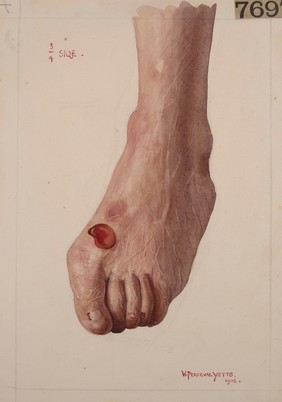 Foot from a case of epidermolysis bullosa