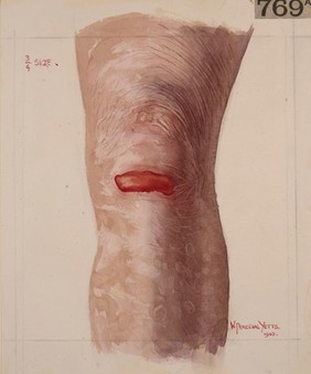 Knee from a case of epidermolysis bullosa